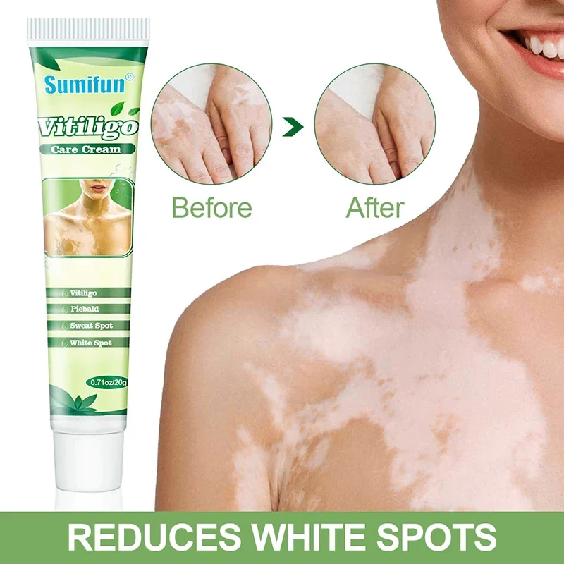 Crema para Manchas de Vitíligo